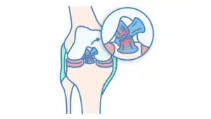 Illustration eines vorderen Kreuzbandrisses im Knie.