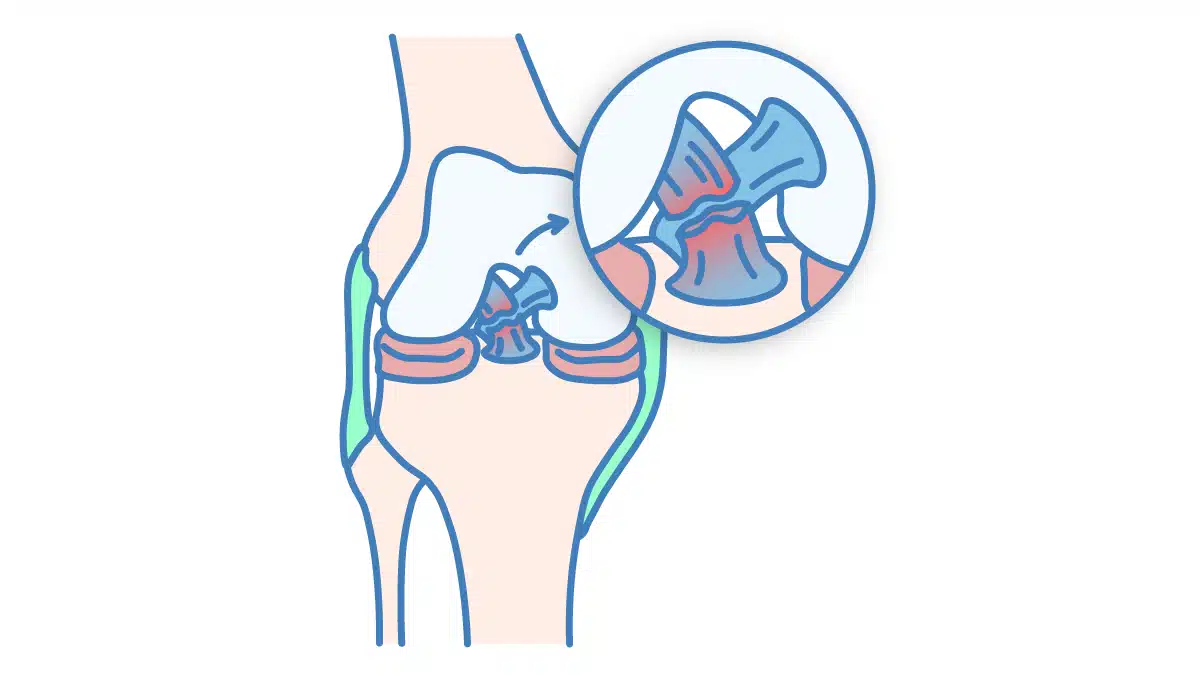 Illustration eines vorderen Kreuzbandrisses im Knie.