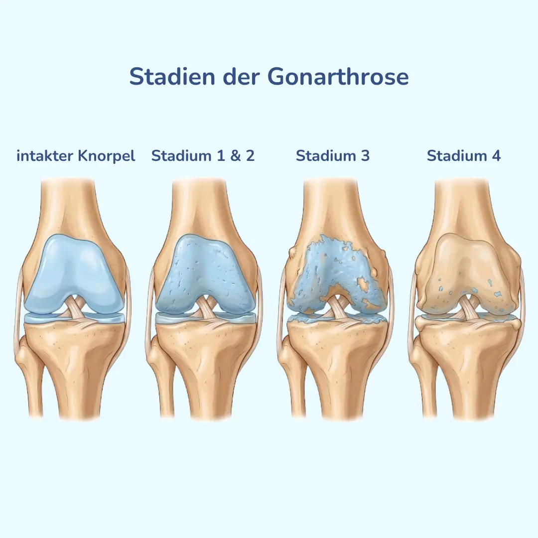 Gonarthrose Stadium 1 bis 4