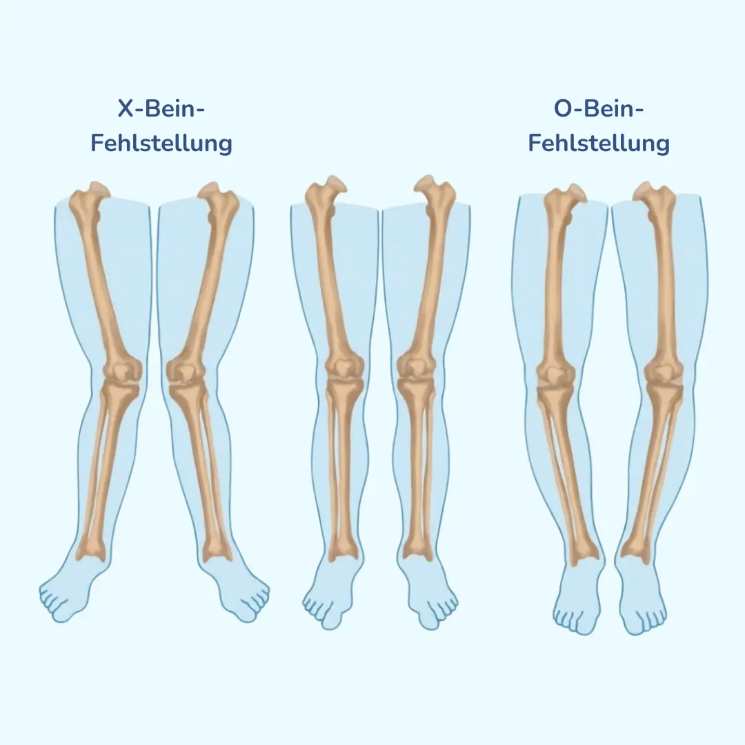Medizinische Darstellung von Beinfehlstellungen wie X-Bein und O-Bein.