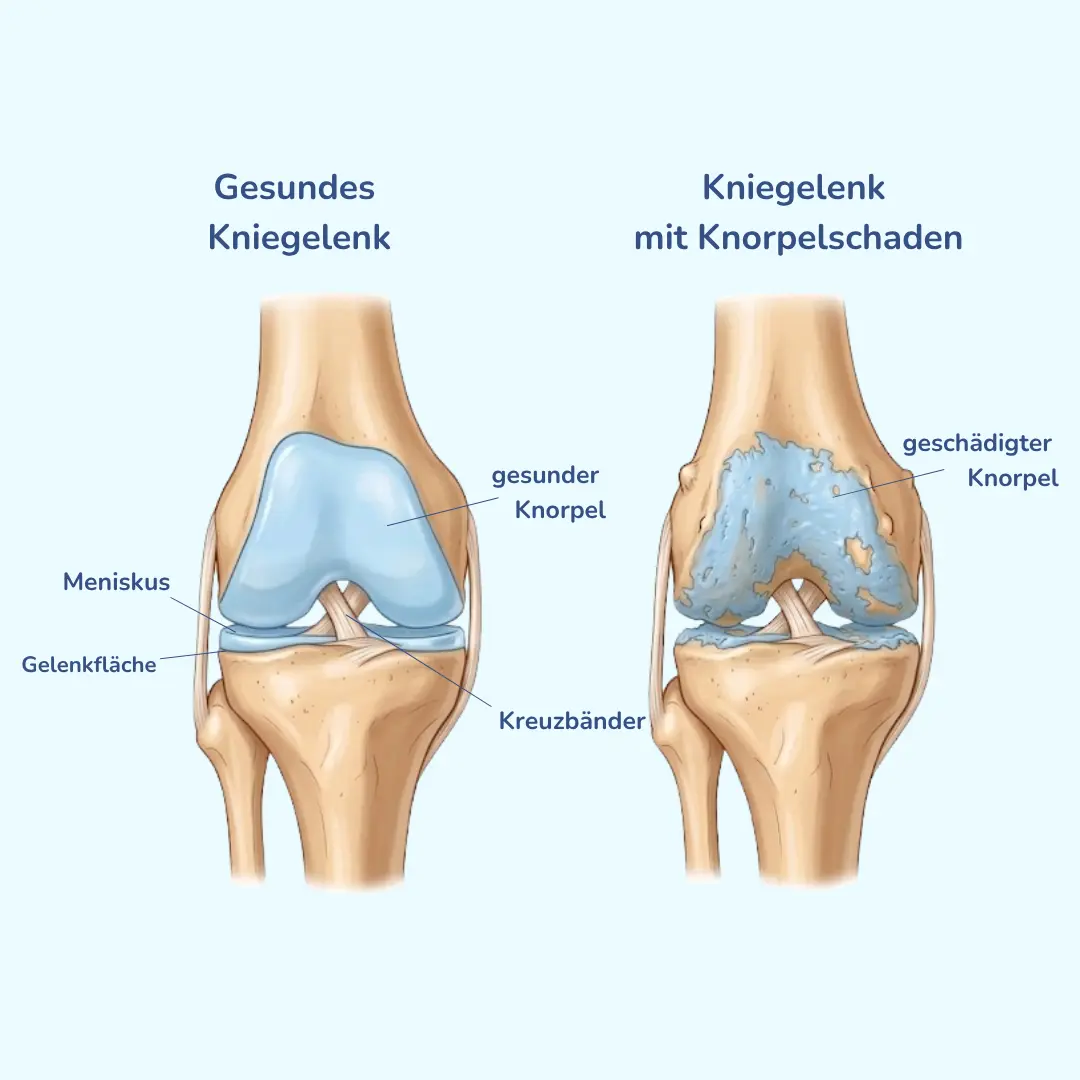 Medizinischer Vergleich zwischen gesundem Knorpel im Kniegelenk und einem Kniegelenk mit Knorpelschaden bei Gonarthrose