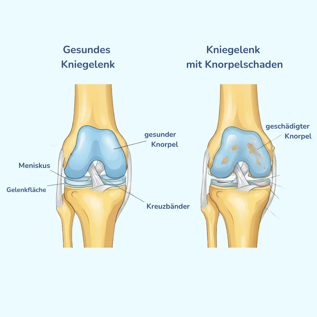 Medizinischer Vergleich zwischen gesundem Knorpel im Kniegelenk und einem Knorpelschaden bei Gonarthrose.