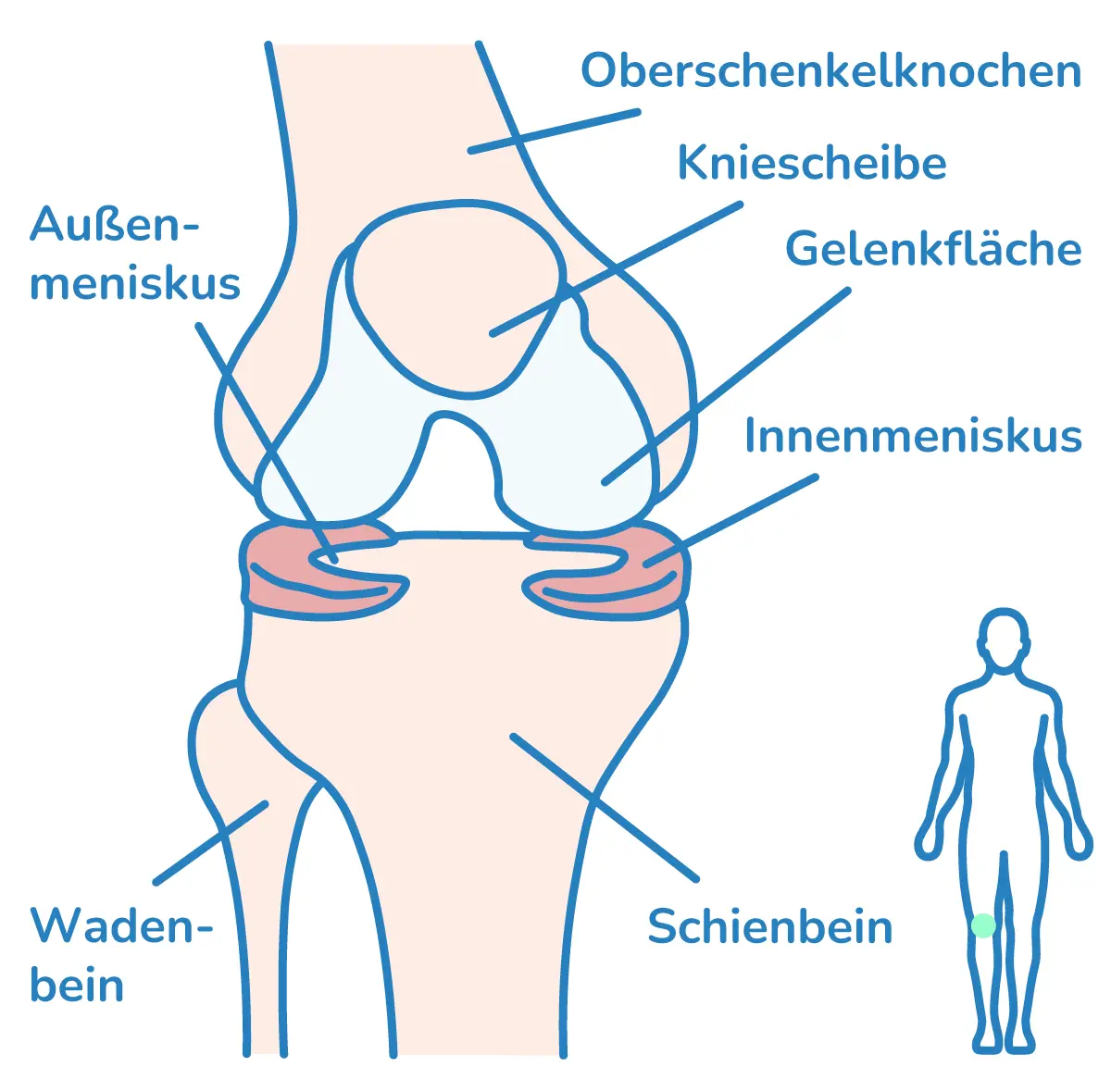 Illustration der Lage der Menisken im Kniegelenk.