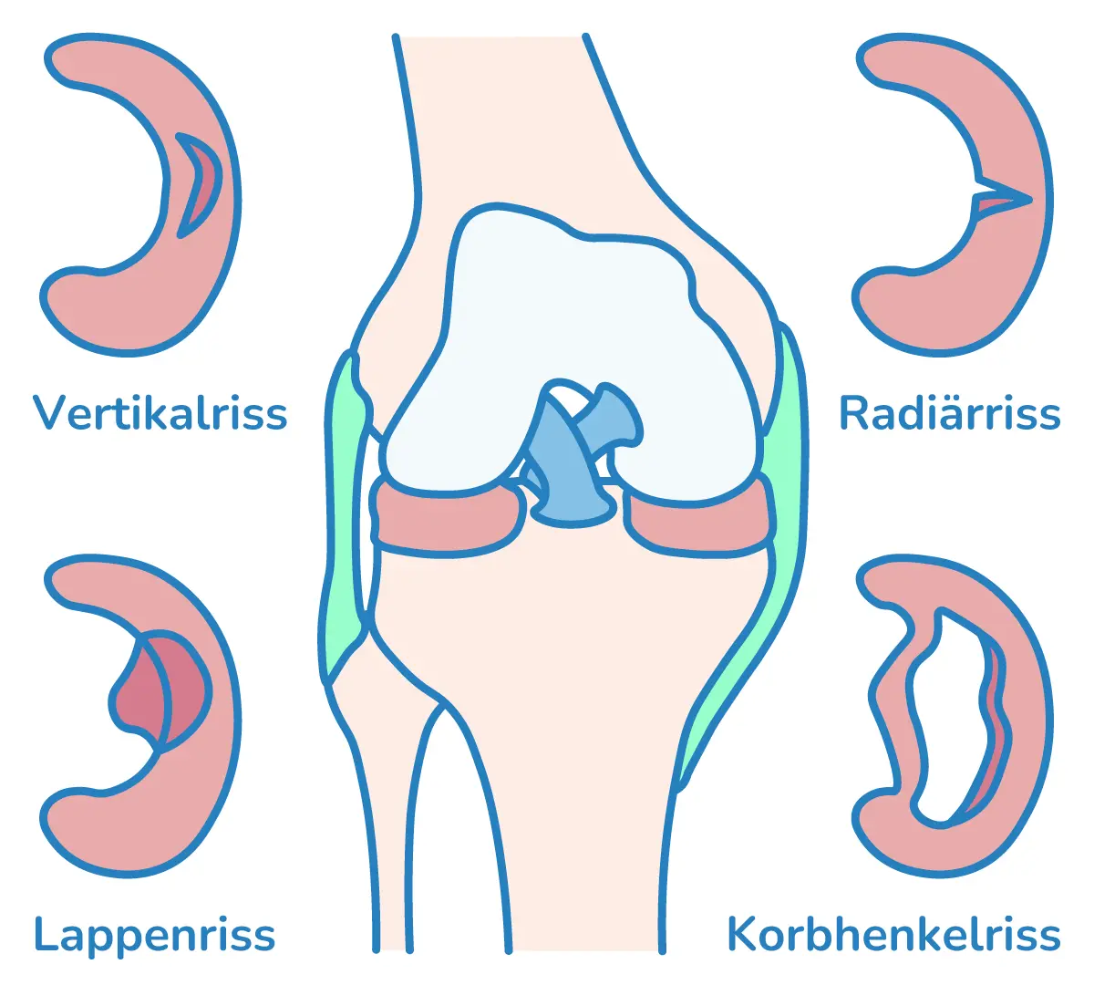 Illustration der Rissformen bei einem Meniskusriss.