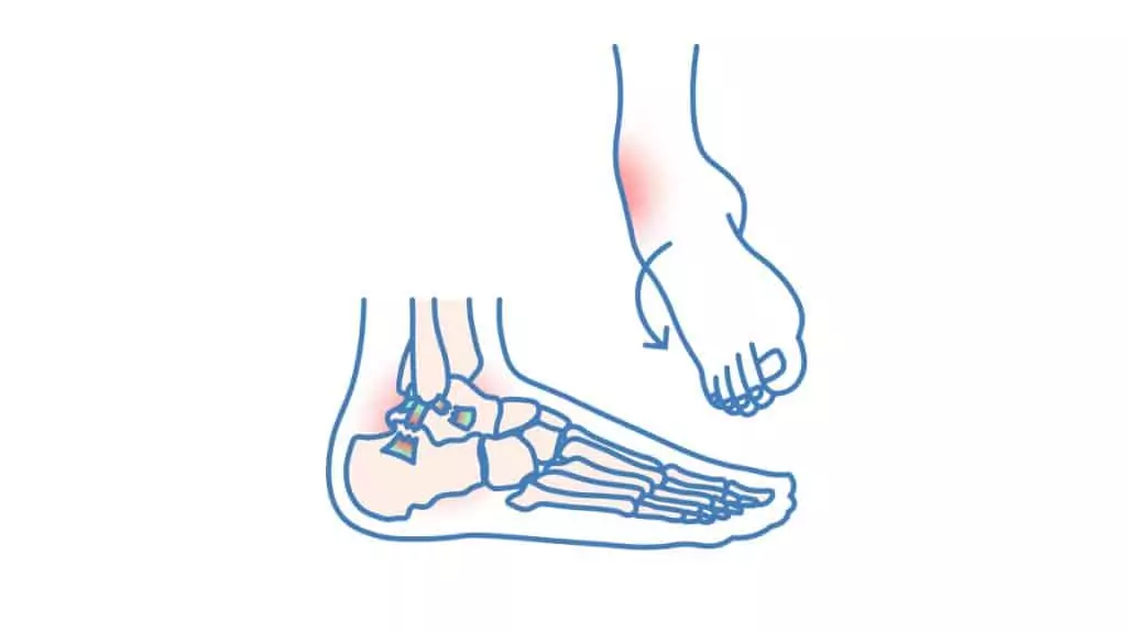 Darstellung eines Bänderrisses im Sprunggelenk mit betroffenen Außenbändern und Symptomen wie Schmerzen und Schwellungen.
