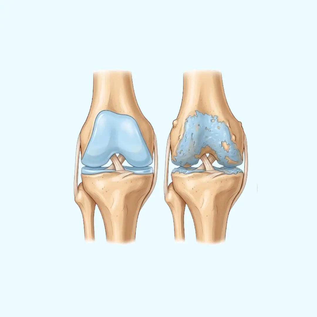Medizinischer Vergleich zwischen einem Kniegelenk mit Gonarthrose und einem Knie mit intaktem Gelenkknorpel