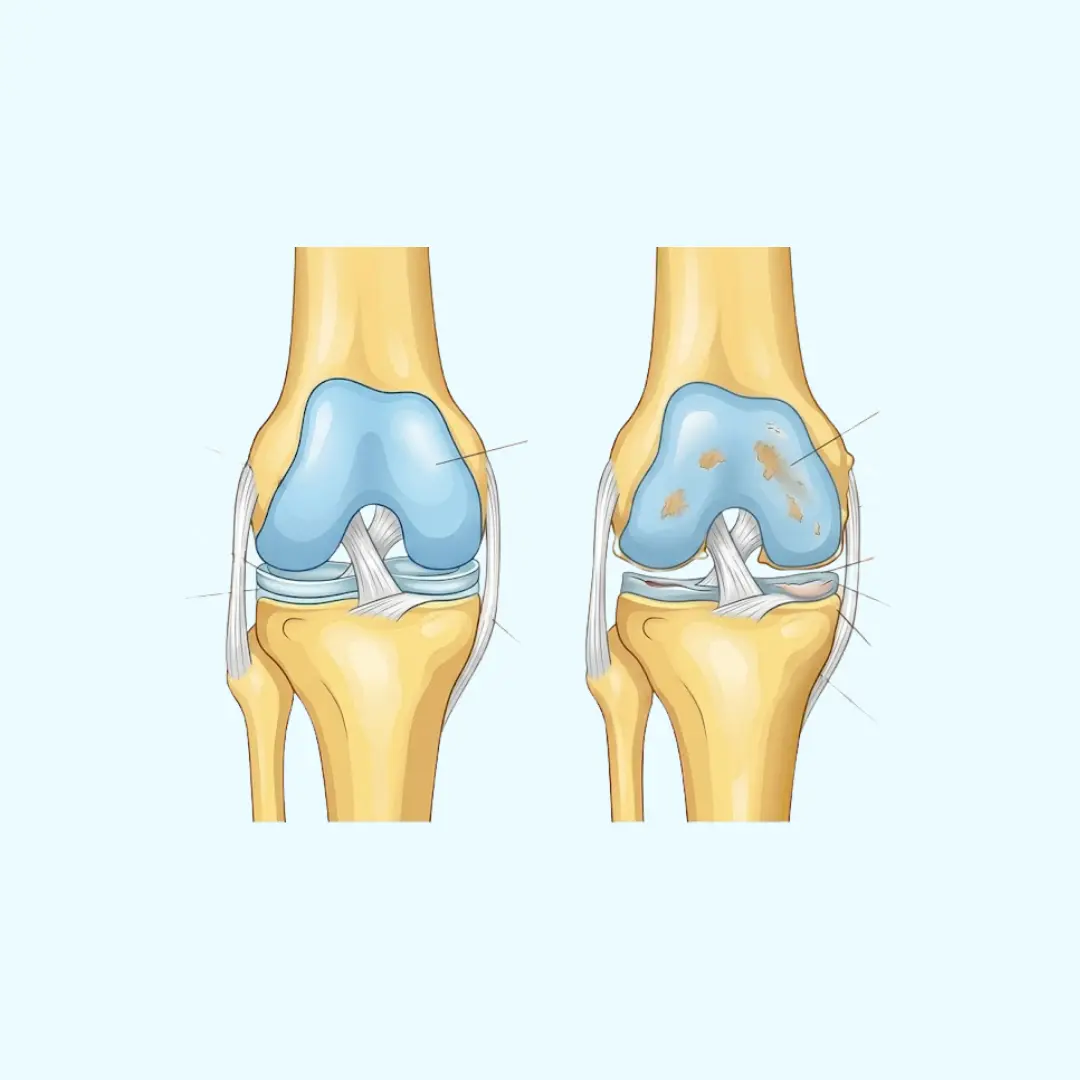 Medizinischer Vergleich zwischen gesundem Knorpel im Kniegelenk und einem Knorpelschaden bei Gonarthrose