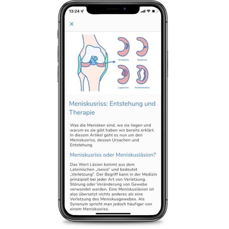Behandlung und Therapie bei Meniskusriss und Meniskusschaden mit Digitaler Physiotherapie App